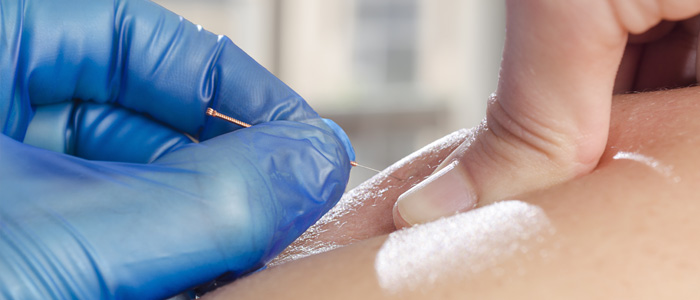 Doctor inserting a needle into clients back
